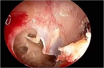 large-central-perforation