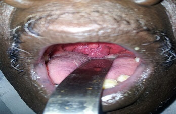 oropharyngeal-rhinosporidiosis